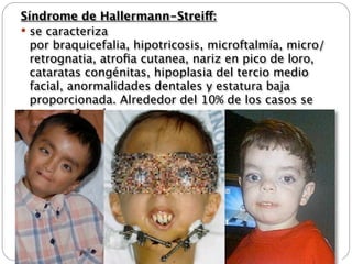 Síndrome de Hallermann-Streiff:
 se caracteriza
  por braquicefalia, hipotricosis, microftalmía, micro/
  retrognatia, atroﬁa cutanea, nariz en pico de loro,
  cataratas congénitas, hipoplasia del tercio medio
  facial, anormalidades dentales y estatura baja
  proporcionada. Alrededor del 10% de los casos se
  acompañan de retraso neuro-motor
 