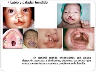  Labio y paladar hendido




       
 
         En general cuando encontramos con alguna
         alteración asociada a síndromes, podemos sospechar que
         vamos a encontrarnos con éste problema en la familia.
 