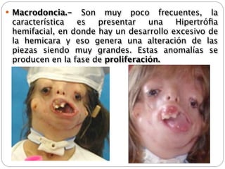  Macrodoncia.-   Son   muy poco frecuentes, la
 característica  es   presentar    una   Hipertróﬁa
 hemifacial, en donde hay un desarrollo excesivo de
 la hemicara y eso genera una alteración de las
 piezas siendo muy grandes. Estas anomalías se
 producen en la fase de proliferación. 
 