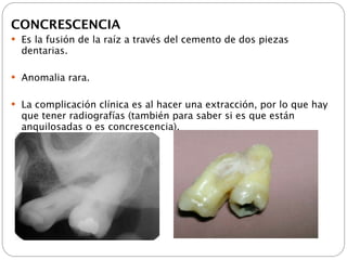 CONCRESCENCIA
 Es la fusión de la raíz a través del cemento de dos piezas
  dentarias.

 Anomalia rara.


 La complicación clínica es al hacer una extracción, por lo que hay
  que tener radiografías (también para saber si es que están
  anquilosadas o es concrescencia).
 