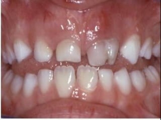 Anomalias dentales