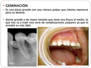 Anomalias dentales