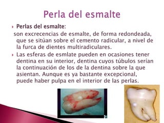  Perlas del esmalte:
son excrecencias de esmalte, de forma redondeada,
que se sitúan sobre el cemento radicular, a nivel de
la furca de dientes multiradiculares.
 Las esferas de esmlate pueden en ocasiones tener
dentina en su interior, dentina cuyos túbulos serían
la continuación de los de la dentina sobre la que
asientan. Aunque es ya bastante excepcional,
puede haber pulpa en el interior de las perlas.
 