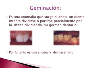  Es una anomalía que surge cuando un diente
intenta dividirse o partirse parcialmente por
la mitad dividiendo su germen dentario.
 Por lo tanto es una anomalía del desarrollo
 
