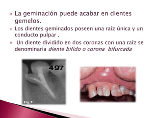  La geminación puede acabar en dientes
gemelos.
 Los dientes geminados poseen una raíz única y un
conducto pulpar .
 Un diente dividido en dos coronas con una raíz se
denominaría diente bifído o corona bifurcada
 