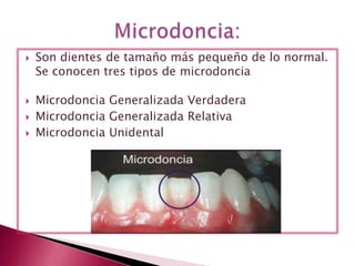  Son dientes de tamaño más pequeño de lo normal.
Se conocen tres tipos de microdoncia
 Microdoncia Generalizada Verdadera
 Microdoncia Generalizada Relativa
 Microdoncia Unidental
 