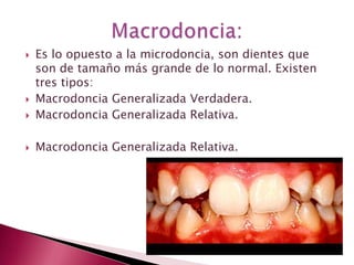  Es lo opuesto a la microdoncia, son dientes que
son de tamaño más grande de lo normal. Existen
tres tipos:
 Macrodoncia Generalizada Verdadera.
 Macrodoncia Generalizada Relativa.
 Macrodoncia Generalizada Relativa.
 