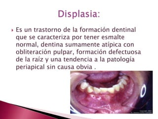  Es un trastorno de la formación dentinal
que se caracteriza por tener esmalte
normal, dentina sumamente atípica con
obliteración pulpar, formación defectuosa
de la raíz y una tendencia a la patología
periapical sin causa obvia .
 