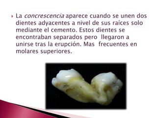  La concrescencia aparece cuando se unen dos
dientes adyacentes a nivel de sus raíces solo
mediante el cemento. Estos dientes se
encontraban separados pero llegaron a
unirse tras la erupción. Mas frecuentes en
molares superiores.
 