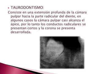  TAURODONTISMO:
Consiste en una extensión profunda de la cámara
pulpar hacia la parte radicular del diente, en
algunos casos la cámara pulpar casi alcanza el
ápice, por lo tanto los conductos radiculares se
presentan cortos y la corona se presenta
desarrollada.
 