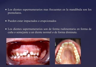 Los dientes supernumerarios mas frecuentes en la mandíbula son losLos dientes supernumerarios mas frecuentes en la mandíbula son los
premolares.premolares.
 Pueden estar impactados o erupcionadosPueden estar impactados o erupcionados
 Los dientes supernumerarios son de forma rudimentaria en forma deLos dientes supernumerarios son de forma rudimentaria en forma de
cuña o semejante a un diente normal o de forma diminuta.cuña o semejante a un diente normal o de forma diminuta.
 