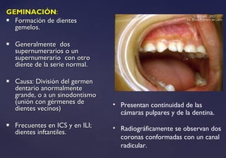 GEMINACIÓNGEMINACIÓN::
 Formación de dientesFormación de dientes
gemelos.gemelos.
 Generalmente dosGeneralmente dos
supernumerarios o unsupernumerarios o un
supernumerario con otrosupernumerario con otro
diente de la serie normal.diente de la serie normal.
 Causa: División del germenCausa: División del germen
dentario anormalmentedentario anormalmente
grande, o a un sinodontismogrande, o a un sinodontismo
(unión con gérmenes de(unión con gérmenes de
dientes vecinos)dientes vecinos)
 Frecuentes en ICS y en ILI;Frecuentes en ICS y en ILI;
dientes inftantiles.dientes inftantiles.
• Presentan continuidad de las
cámaras pulpares y de la dentina.
• Radiográficamente se observan dos
coronas conformadas con un canal
radicular.
 