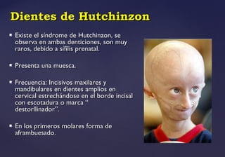 Dientes de HutchinzonDientes de Hutchinzon
 Existe el síndrome de Hutchinzon, seExiste el síndrome de Hutchinzon, se
observa en ambas denticiones, son muyobserva en ambas denticiones, son muy
raros, debido a sífilis prenatal.raros, debido a sífilis prenatal.
 Presenta una muesca.Presenta una muesca.
 Frecuencia: Incisivos maxilares yFrecuencia: Incisivos maxilares y
mandibulares en dientes amplios enmandibulares en dientes amplios en
cervical estrechándose en el borde incisalcervical estrechándose en el borde incisal
con escotadura o marca “con escotadura o marca “
destorllinador”.destorllinador”.
 En los primeros molares forma deEn los primeros molares forma de
aframbuesado.aframbuesado.
 