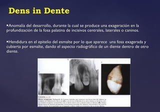 Dens in Dente
Anomalía del desarrollo, durante la cual se produce una exageración en laAnomalía del desarrollo, durante la cual se produce una exageración en la
profundización de la fosa palatina de incisivos centrales, laterales o caninos.profundización de la fosa palatina de incisivos centrales, laterales o caninos.
Hendidura en el epitelio del esmalte por lo que aparece una fosa exagerada yHendidura en el epitelio del esmalte por lo que aparece una fosa exagerada y
cubierta por esmalte, dando el aspecto radiográfico de un diente dentro de otrocubierta por esmalte, dando el aspecto radiográfico de un diente dentro de otro
diente.diente.
 