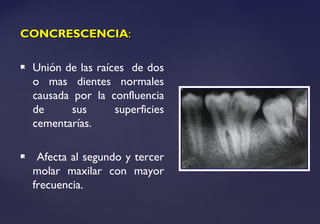 CONCRESCENCIACONCRESCENCIA::
 Unión de las raíces de dos
o mas dientes normales
causada por la confluencia
de sus superficies
cementarías.
 Afecta al segundo y tercer
molar maxilar con mayor
frecuencia.
 