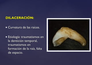 DILACERACIÓN:DILACERACIÓN:
 Curvatura de las raíces.Curvatura de las raíces.
 Etiología: traumatismos enEtiología: traumatismos en
la dentición temporal,la dentición temporal,
traumatismos entraumatismos en
formación de la raíz, faltaformación de la raíz, falta
de espacio.de espacio.
 