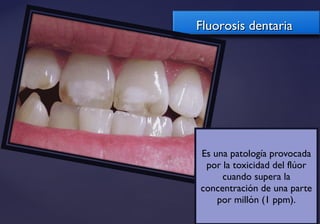 {{
Fluorosis dentariaFluorosis dentaria
Es una patología provocada
por la toxicidad del flúor
cuando supera la
concentración de una parte
por millón (1 ppm).
 