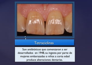 {{
TetraciclinasTetraciclinas
Son antibióticos que comenzaron a ser
desarrollados en 1948, su ingesta por parte de
mujeres embarazadas o niños a corta edad
produce alteraciones dentarias.
 