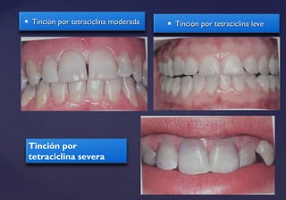  Tinción por tetraciclina moderadaTinción por tetraciclina moderada  Tinción por tetraciclina leveTinción por tetraciclina leve
Tinción por
tetraciclina severa
 