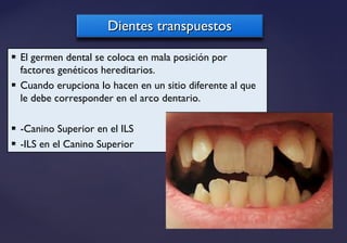 Dientes transpuestosDientes transpuestos
 El germen dental se coloca en mala posición por
factores genéticos hereditarios.
 Cuando erupciona lo hacen en un sitio diferente al que
le debe corresponder en el arco dentario.
 -Canino Superior en el ILS
 -ILS en el Canino Superior
 
