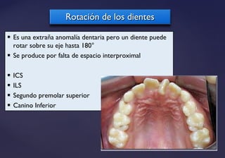 Rotación de los dientesRotación de los dientes
 Es una extraña anomalía dentaria pero un diente puede
rotar sobre su eje hasta 180°
 Se produce por falta de espacio interproximal
 ICS
 ILS
 Segundo premolar superior
 Canino Inferior
 