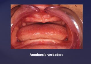 Anodoncia verdadera
 