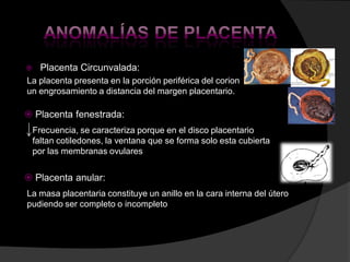    Placenta Circunvalada:
La placenta presenta en la porción periférica del corion
un engrosamiento a distancia del marge...