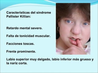 Características del síndrome
Pallister Killian:
Retardo mental severo.
Falta de tonicidad muscular.
Facciones toscas.
Frente prominente.
Labio superior muy delgado, labio inferior más grueso y
la nariz corta.
 