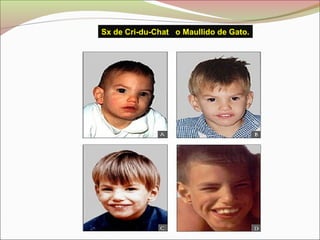 Sx de Cri-du-Chat o Maullido de Gato.
 