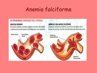Anemia falciforme
 