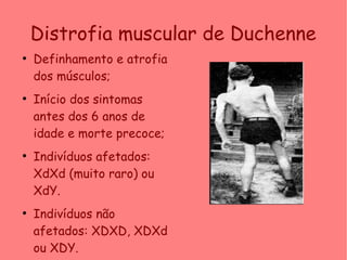Distrofia muscular de Duchenne
●
Definhamento e atrofia
dos músculos;
●
Início dos sintomas
antes dos 6 anos de
idade e morte precoce;
●
Indivíduos afetados:
XdXd (muito raro) ou
XdY.
●
Indivíduos não
afetados: XDXD, XDXd
ou XDY.
 