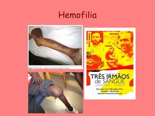 Hemofilia
 