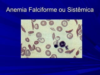 Anemia Falciforme ou Sistêmica
 