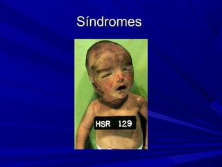 Síndromes
 