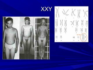 XXY
 