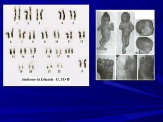 Anomalias genéticas na espécie humana