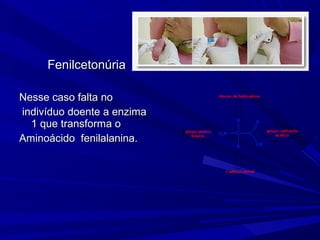 Fenilcetonúria

Nesse caso falta no
indivíduo doente a enzima
  1 que transforma o
Aminoácido fenilalanina.
 
