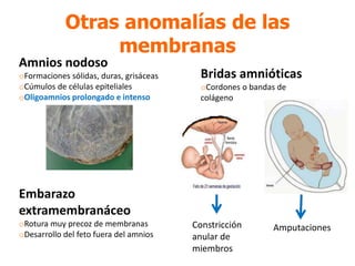 Otras anomalías de las
membranas
Amnios nodoso
oFormaciones sólidas, duras, grisáceas
oCúmulos de células epiteliales
oOligoamnios prolongado e intenso
Bridas amnióticas
oCordones o bandas de
colágeno
Constricción
anular de
miembros
Amputaciones
Embarazo
extramembranáceo
oRotura muy precoz de membranas
oDesarrollo del feto fuera del amnios
 