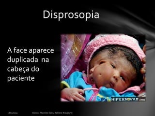 Disprosopia
A face aparece
duplicada na
cabeça do
paciente