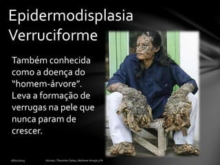 Epidermodisplasia
Verruciforme
Também conhecida
como a doença do
“homem-árvore”.
Leva a formação de
verrugas na pele que
nunca param de
crescer.