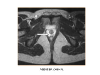 AGENESIA VAGINAL
 