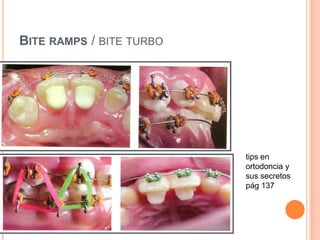 Anomalias verticales ortodoncia diagnostico y tratamiento | PPTX