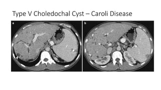 Caroli Types Anomalies and Anatomic Variants of the Biliary Tract.pptx