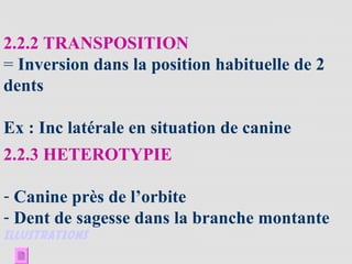 2.2.2 TRANSPOSITION
= Inversion dans la position habituelle de 2
dents
Ex : Inc latérale en situation de canine
2.2.3 HETEROTYPIE
- Canine près de l’orbite
- Dent de sagesse dans la branche montante
ILLUSTRATIONS
 