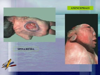 ANENCEPHALY




SPINA BIFIDA
 