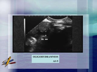 OLIGOHYDRAMNIOS
           AI<5
 