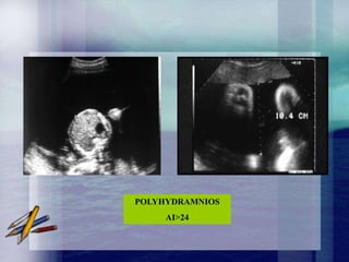 POLYHYDRAMNIOS
     AI>24
 