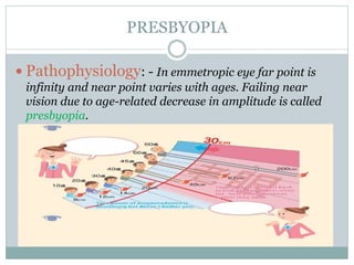 PRESBYOPIA
 Pathophysiology: - In emmetropic eye far point is
infinity and near point varies with ages. Failing near
visi...