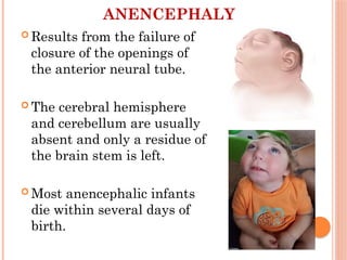 Anomalies of CNS+ Hydrocephalus in neonate.pptx