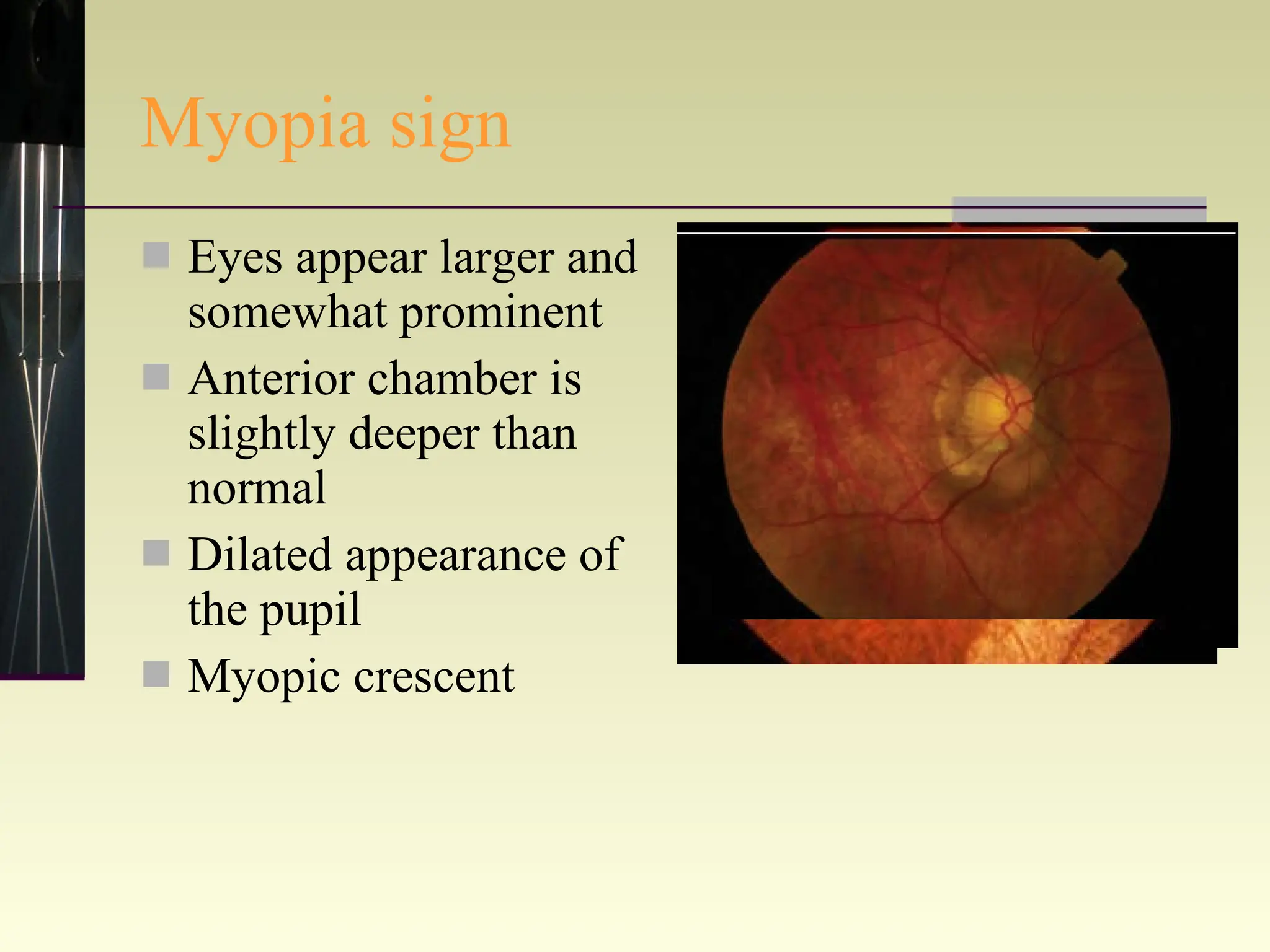 Myopia sign Eyes appear larger and somewhat prominent Anterior chamber is slightly deeper than normal Dilated appearance of the pupil Myopic crescent 